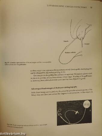 Laparoscopic Biliary Surgery