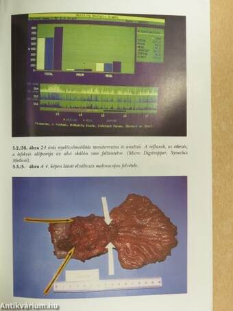 Gastro-oesophagealis reflux betegség: válogatott kérdések és vezérfonal a kezeléshez