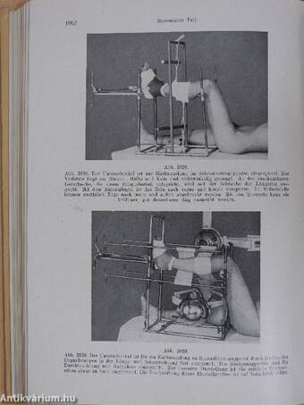 Technik der Knochenbruchbehandlung im Frieden und im Kriege III.