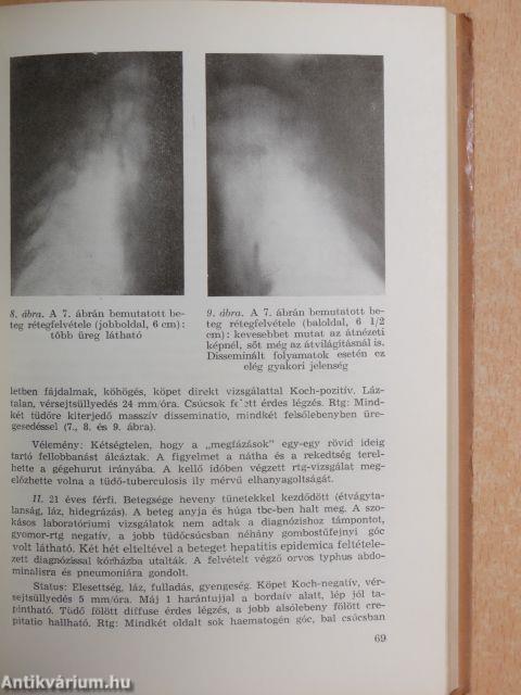 A tuberculosis az általános orvosi gyakorlatban