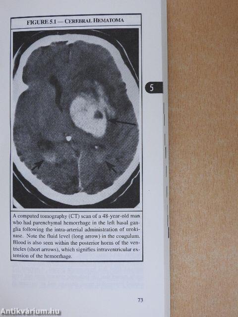 Management of Stroke