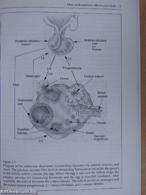 Endometriosis