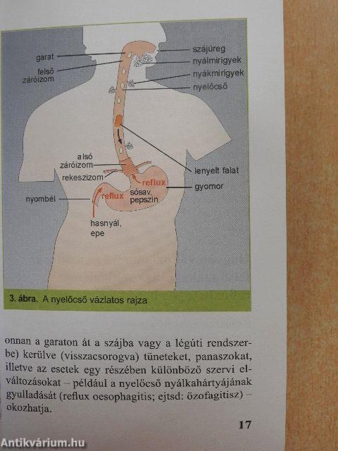 Refluxbetegség - gyomorsav okozta bántalmak