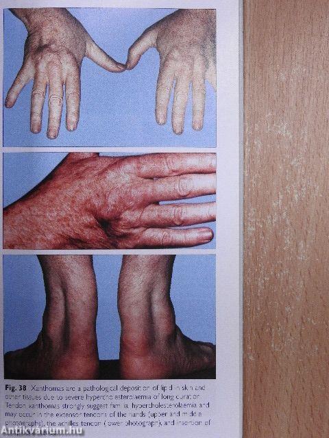 Lipids and Lipid Disorders