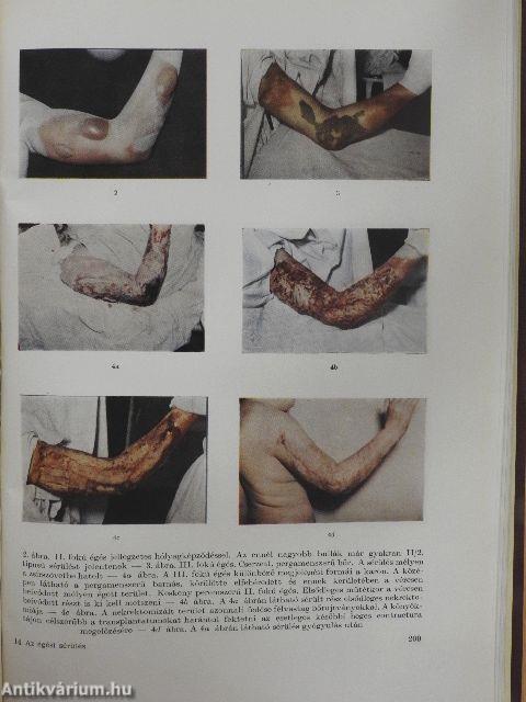 Az égési sérülés műtéti kezelésének elmélete és gyakorlata