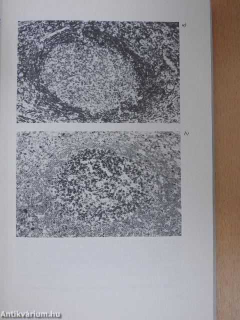 Non-Hodgkin lymphoma