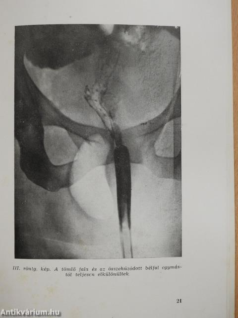 Szülési sérülésből eredő implantatios, légtartalmú hüvelycysta (dedikált példány)