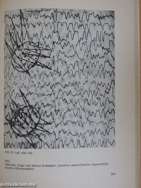 Epilepsie und Antiepileptika