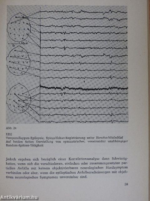 Epilepsie und Antiepileptika