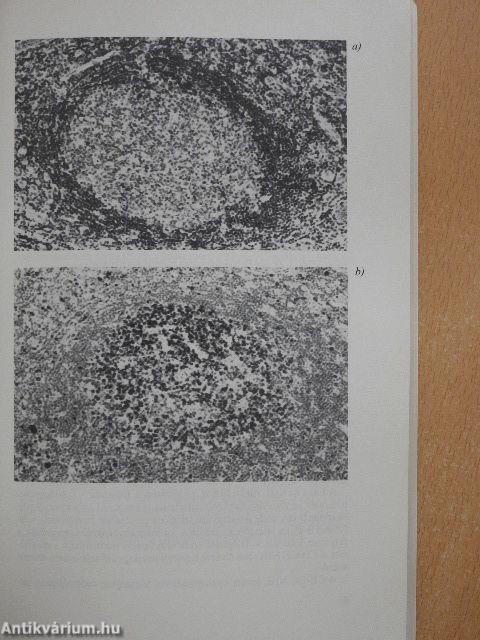 Non-Hodgkin lymphoma