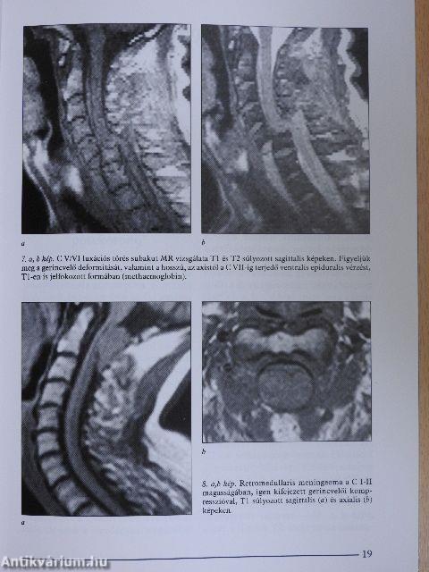 A nyaki gerinc képalkotó diagnosztikája