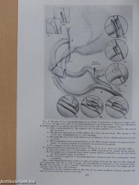 The Treatment of Recurring Acute Pancreatitis by Decompression of the Biliary Tract