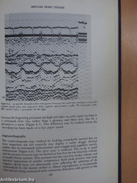 Heart Muscle Disease