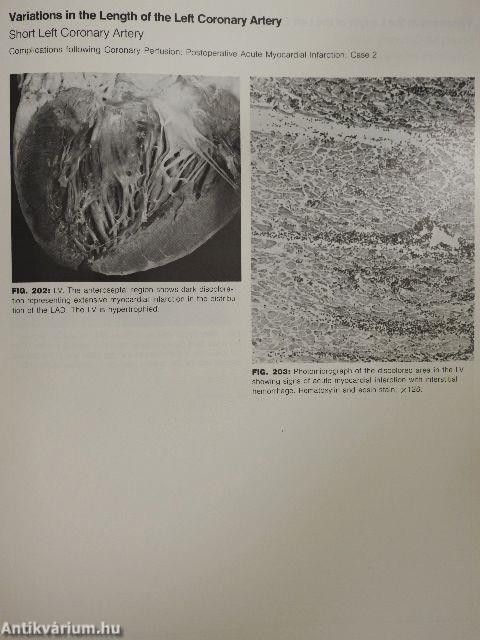 Coronary Heart Disease