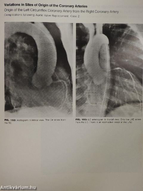 Coronary Heart Disease