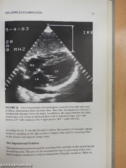 Doppler Echocardiography in Heart Disease