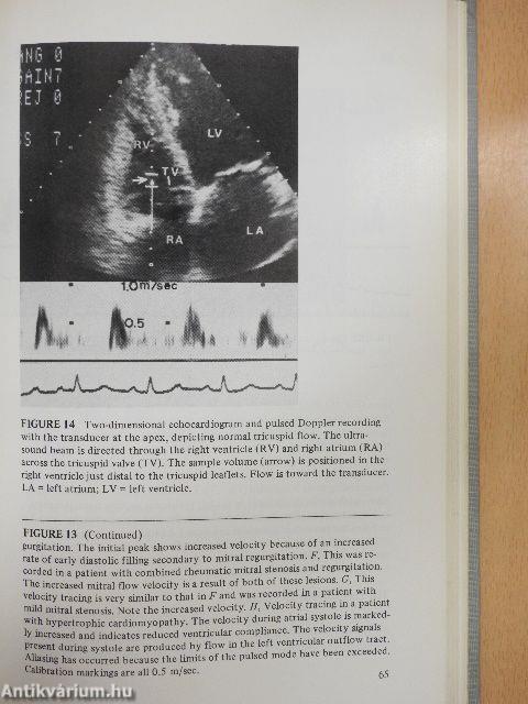 Doppler Echocardiography in Heart Disease