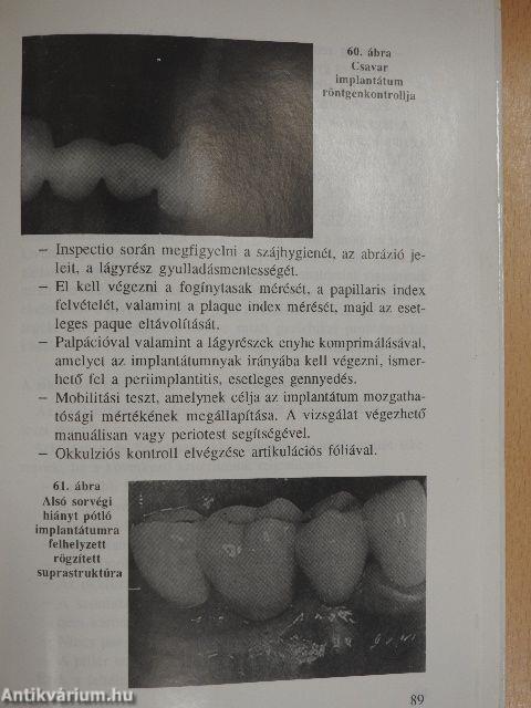 Tájékozódás a fogászati beültetés tudományáról