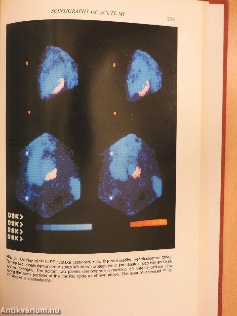 Ischemic Heart Disease