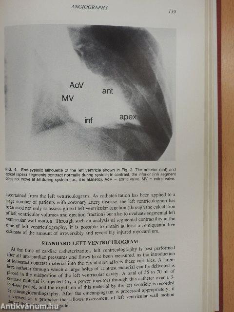 Ischemic Heart Disease