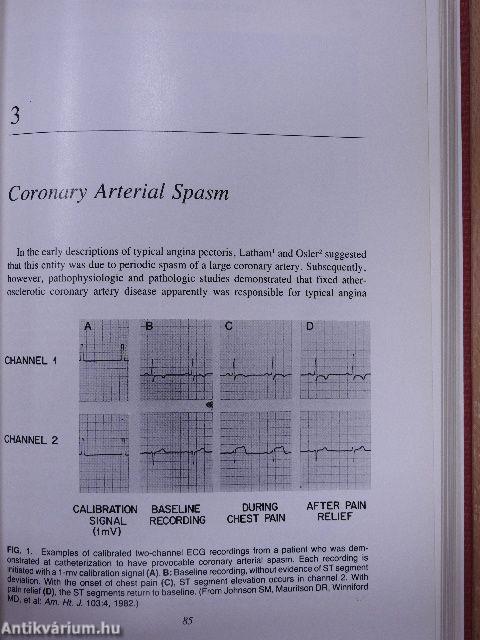 Ischemic Heart Disease