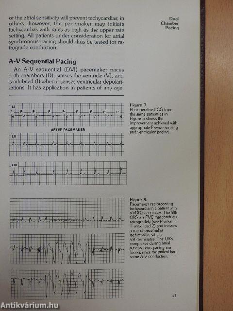 Current Clinical Applications of Dual-Chamber Pacing