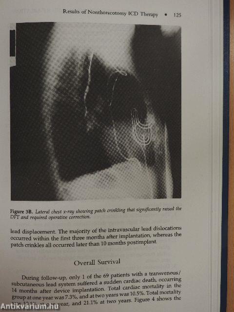 Transvenous Defibrillation and Radiofrequency Ablation