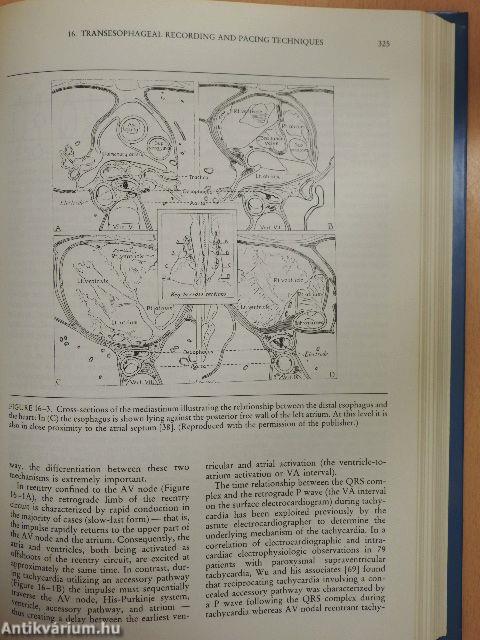 Cardiac Preexcitation Syndromes