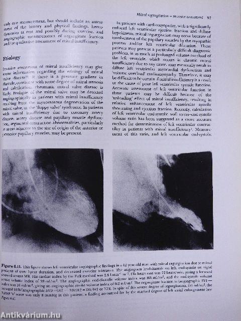 Mitral Valve Disease