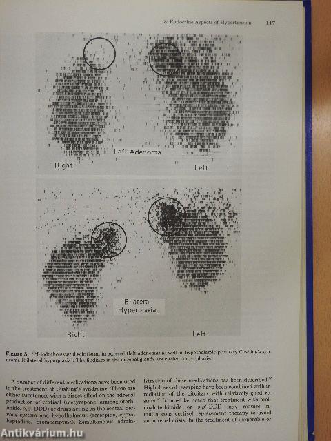 Arterial Hypertension