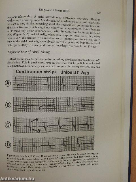 Diagnosis and Treatment of Cardiac Arrhythmias Following Open Heart Surgery