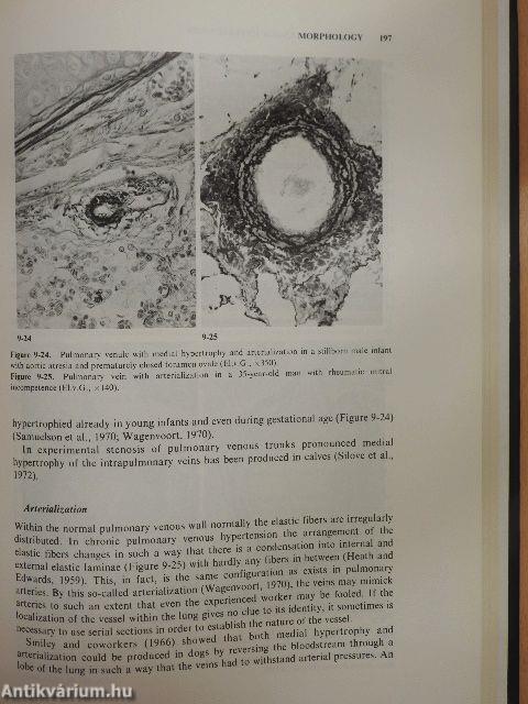 Pathology of Pulmonary Hypertension