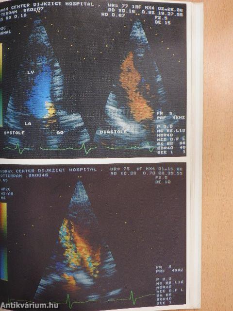 Color Doppler Flow Imaging and other advances in Doppler echocardiography