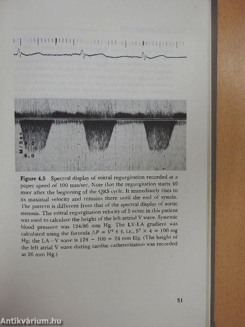 Doppler Echocardiography