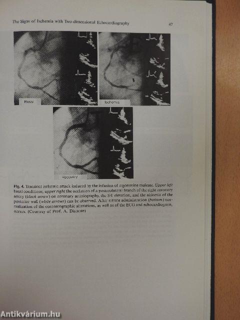 Stress Echocardiography