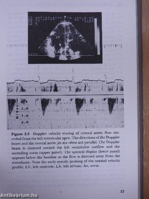 Doppler Echocardiography