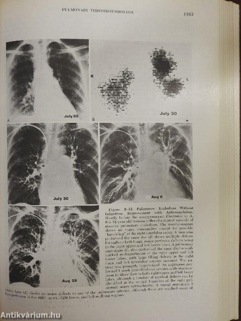 Diagnosis of Diseases of the Chest II. (töredék)