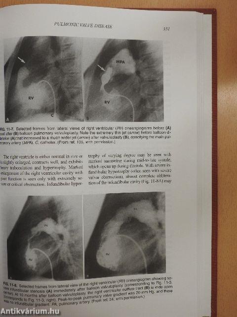 Valvular Heart Disease