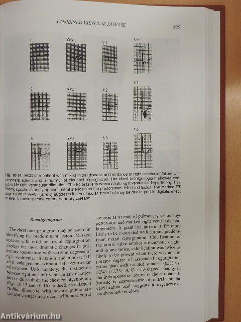 Valvular Heart Disease