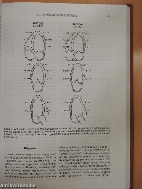 Valvular Heart Disease