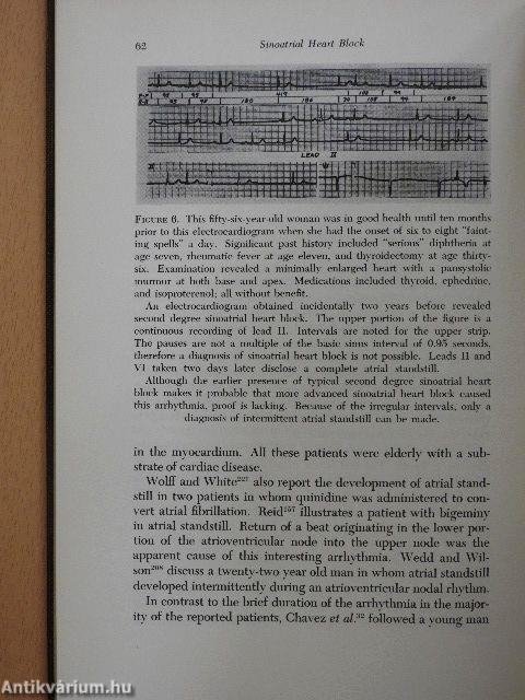 Sinoatrial Heart Block