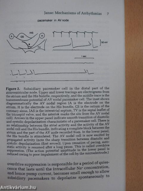 Mechanisms of Arrhythmias