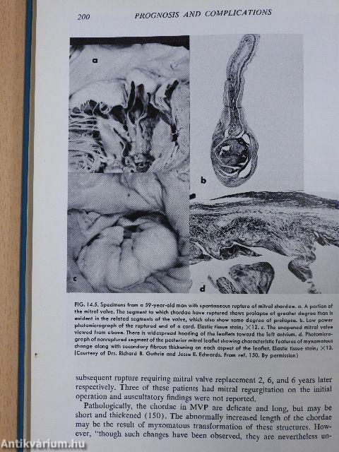 Mitral Valve Prolapse