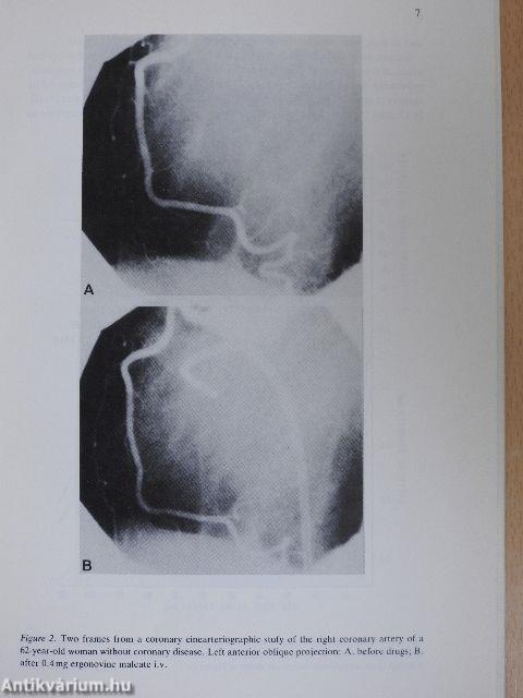 Coronary Tone in Ischemic Heart Disease