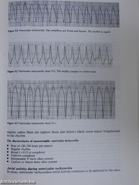 Cardiac Arrhythmias