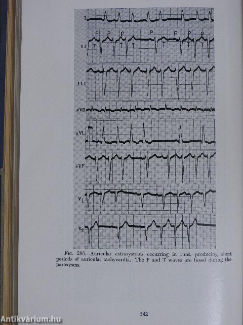 Clinical Unipolar Electrocardiography