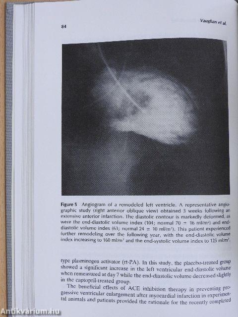 Congestive Cardiac Failure