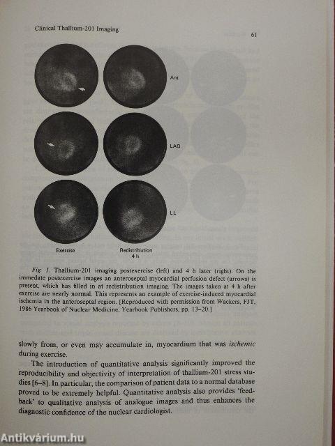 Evaluation of Myocardial Perfusion in Man