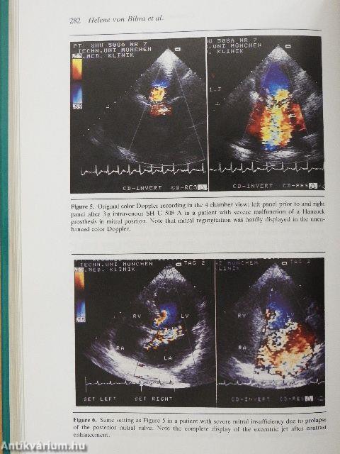 Advances in Echo Imaging Using Contrast Enhancement