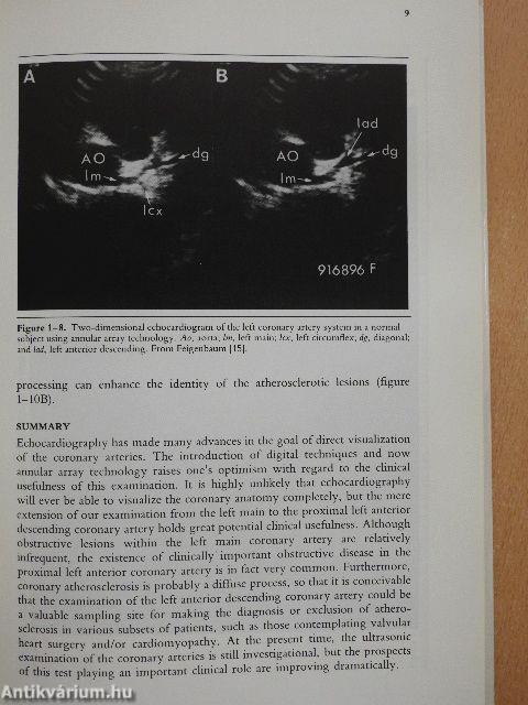 Echocardiography in Coronary Artery Disease